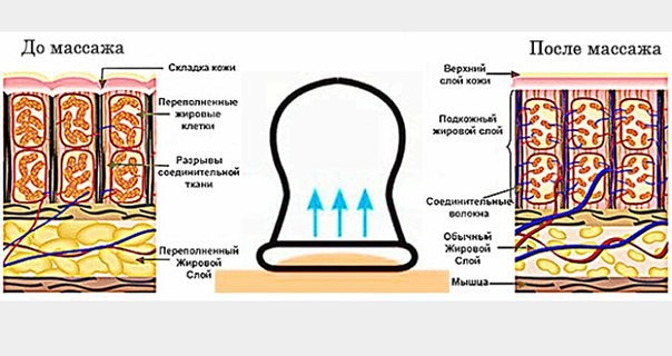 Действие банок Действие банок