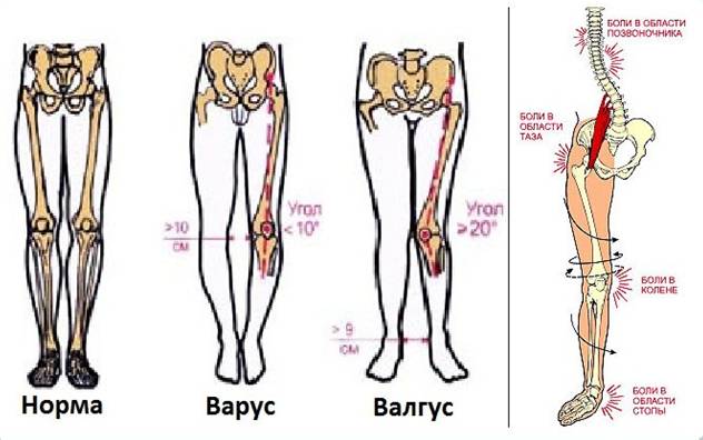 Вальгусное искривление коленей Вальгусное искривление коленей