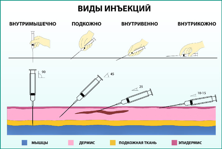 Варианты введения инъекций Варианты введения инъекций