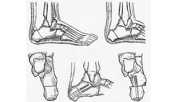 Варизирующая остеотомия пяточной кости при плоскостопии Варизирующая остеотомия пяточной кости при плоскостопии
