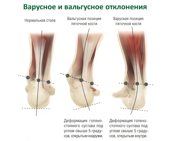 Варусное и вальгусное отклонение стопы Варусное и вальгусное отклонение стопы