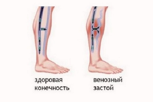 Венозный стаз Венозный стаз