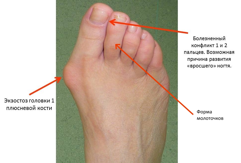 Видимые изменения при вальгусной деформации Видимые изменения при вальгусной деформации