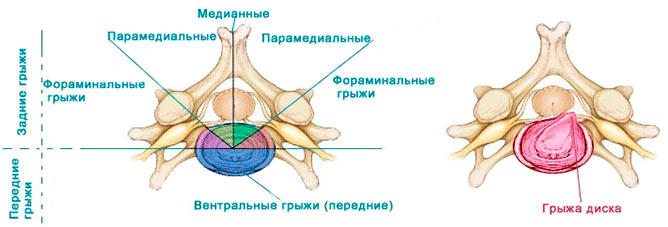Виды грыжи по расположению Виды грыжи по расположению