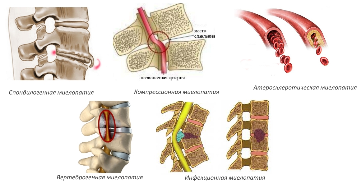 Виды миелопатии Виды миелопатии
