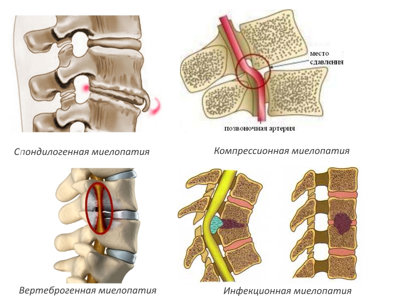 Виды миелопатии Виды миелопатии
