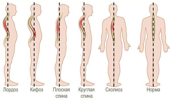 Виды нарушения осанки Виды нарушения осанки