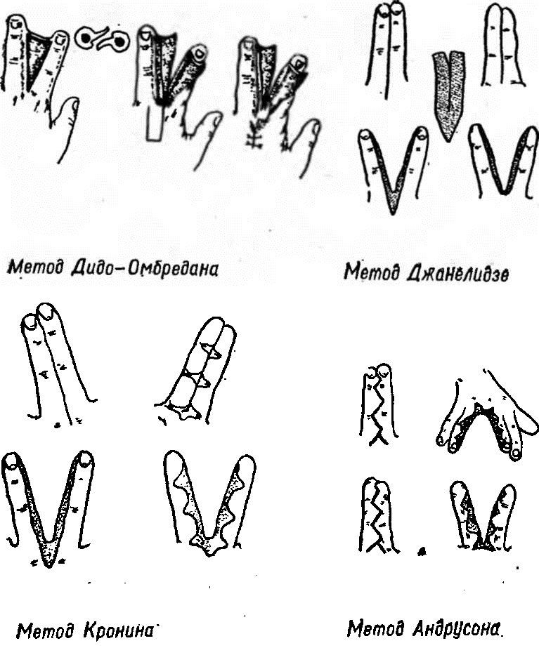 Способы оперативного разделения пальцев Способы оперативного разделения пальцев