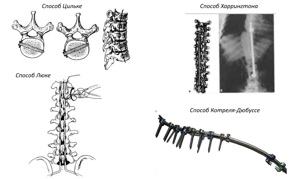 Методы оперативного лечения сколиоза Методы оперативного лечения сколиоза