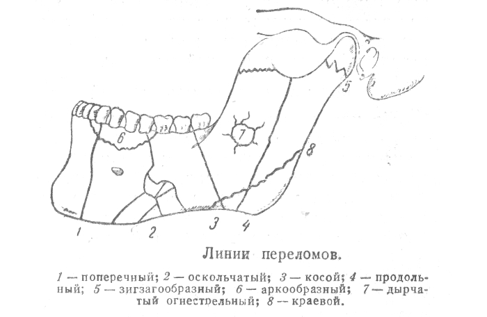 Виды переломов нижней челюсти Виды переломов нижней челюсти