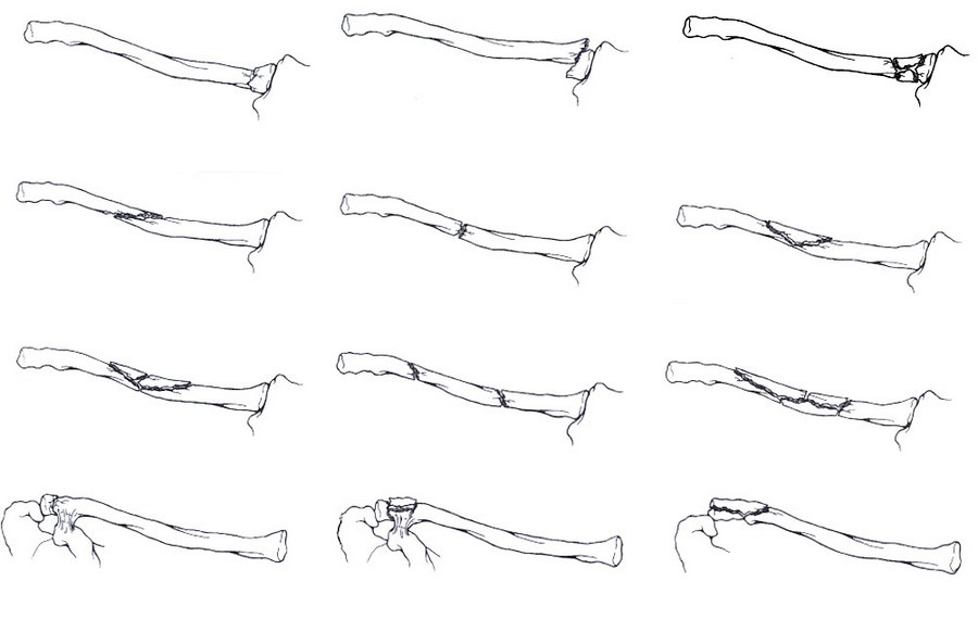 Виды переломов ключицы Виды переломов ключицы