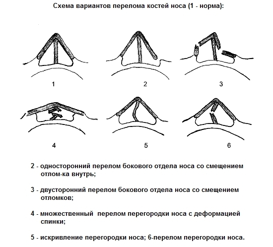 Виды переломов носа Виды переломов носа