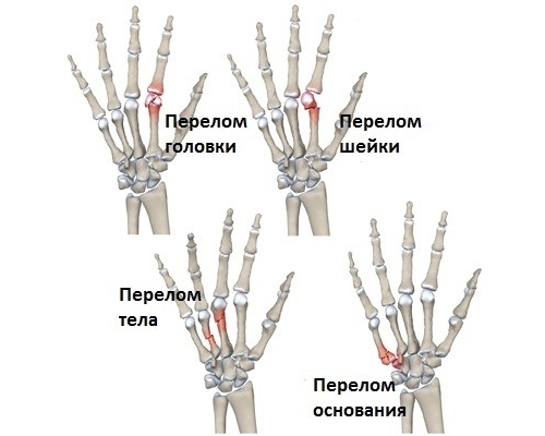 Виды переломов пальца по месту расположения Виды переломов пальца по месту расположения