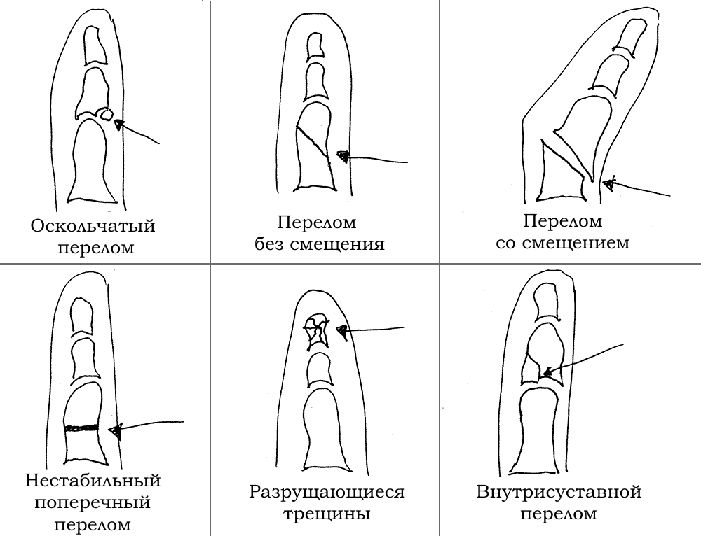 Виды переломов фалангов пальцев Виды переломов фалангов пальцев