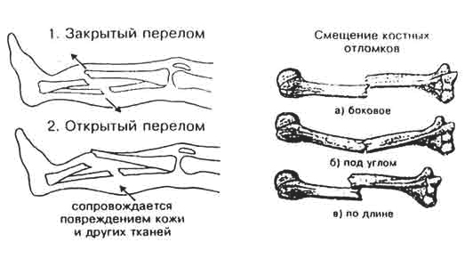 Виды переломов Виды переломов