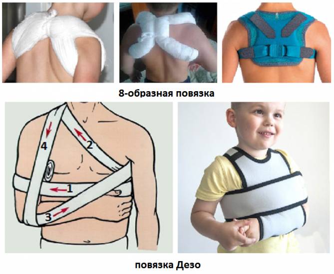 Виды повязок при переломе ключицы Виды повязок при переломе ключицы