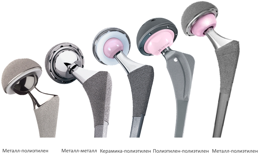 Виды материала для эндопротезов тазобедренного сустава Виды материала для эндопротезов тазобедренного сустава