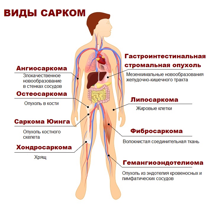 Виды сарком