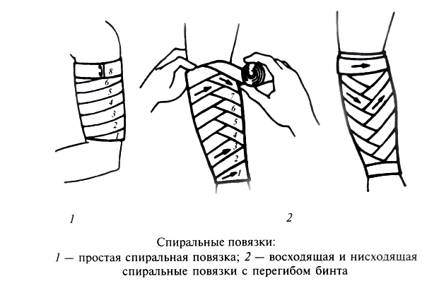 Виды спиральных повязок Виды спиральных повязок