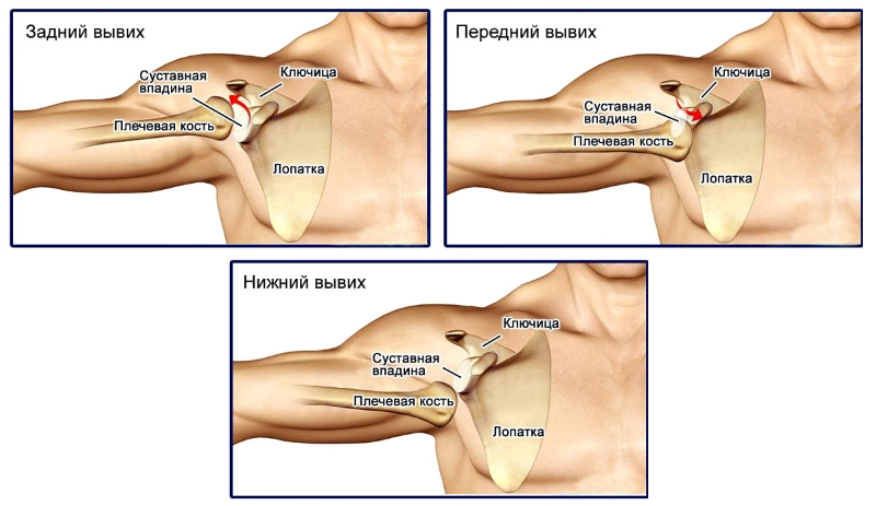 Виды вывиха плечевого сустава Виды вывиха плечевого сустава
