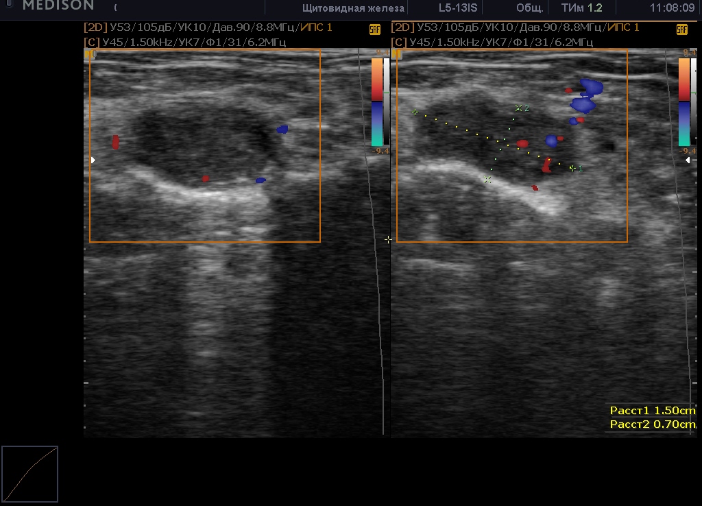 Виллонодулярный синовиит голеностопного сустава на УЗИ Виллонодулярный синовиит голеностопного сустава на УЗИ