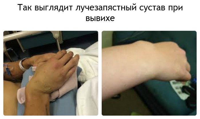 Визуальные признаки вывиха руки