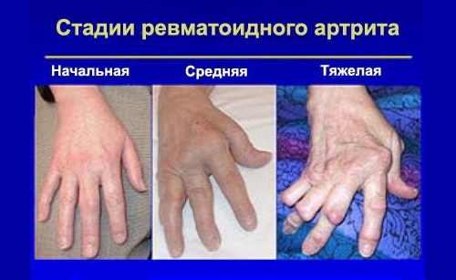 Визуальные стадии ревматоидного артрита Визуальные стадии ревматоидного артрита