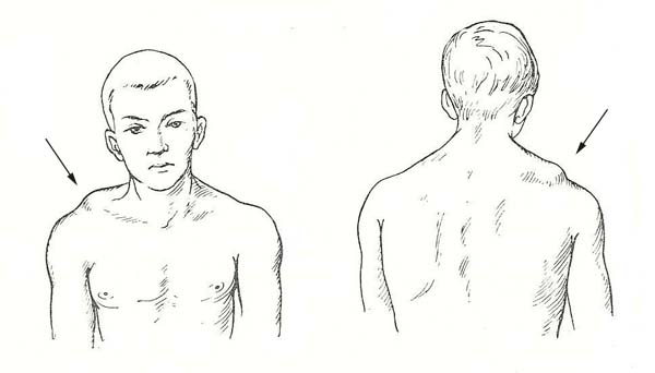 Визуальный выступ ключицы при вывихе Визуальный выступ ключицы при вывихе