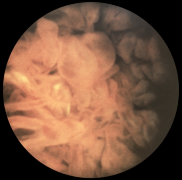 Ворсинчато-узелковый синовит Ворсинчато-узелковый синовит