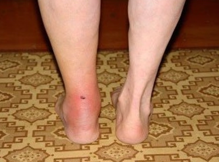 Воспаление ахиллова сухожилия