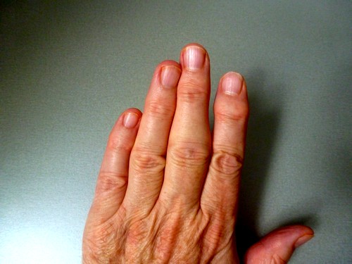 Опухание суставов рук Воспаление и опухание суставов рук