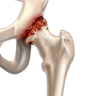 Инфекционное воспаление при коксартрите Инфекционное воспаление при коксартрите