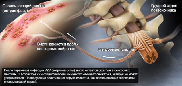 Воспаление нерва на фоне опоясывающего лишая Воспаление нерва на фоне опоясывающего лишая