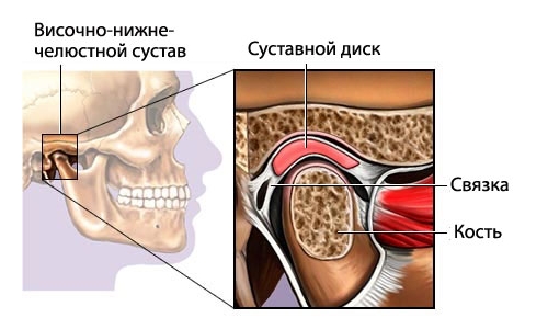 Воспаление височно-челюстного сустава Воспаление височно-челюстного сустава
