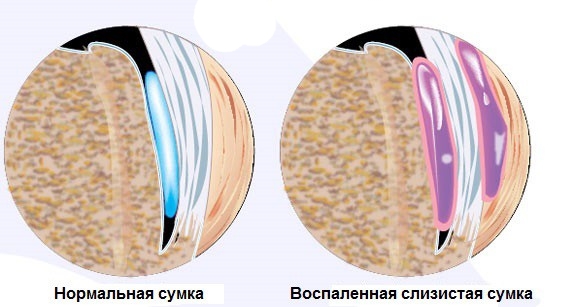 Бурсит - воспаление суставной слизистой сумки Бурсит - воспаление суставной слизистой сумки