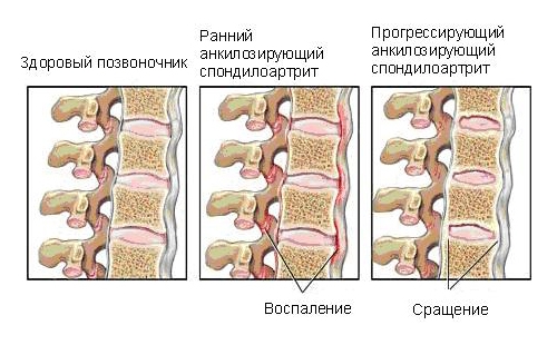 Воспалительный процесс и сращение позвонков при спондилоартрите Воспалительный процесс и сращение позвонков при спондилоартрите