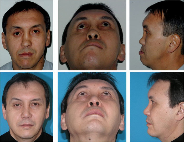 Восстановление деформации челюсти Восстановление деформации челюсти