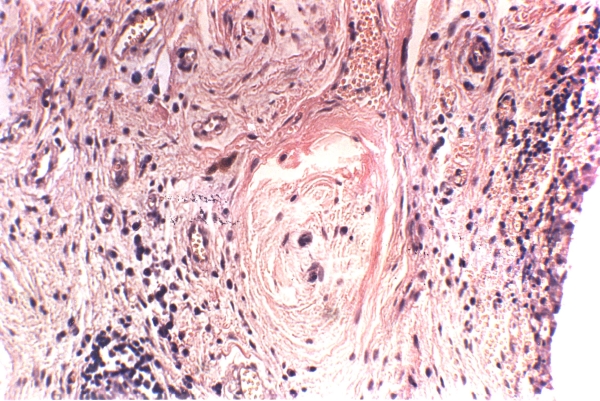 Восстановление хрящевой ткани Восстановление хрящевой ткани
