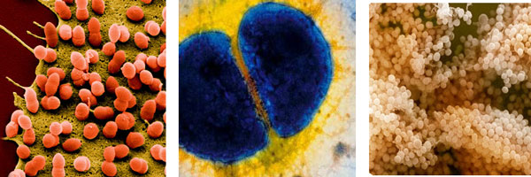 Возбудители инфекционного артрита - стрептококк, гонококк, стафилококк Возбудители инфекционного артрита - стрептококк, гонококк, стафилококк