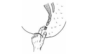 Вправление копчика через прямую кишку Вправление копчика через прямую кишку