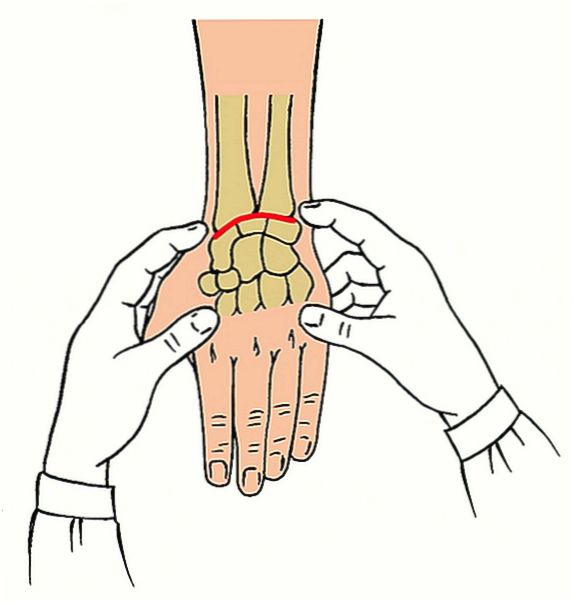 Вправление вывиха кисти Вправление вывиха кисти