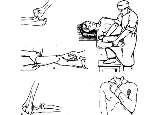 Вправление вывиха локтевого сустава Вправление вывиха локтевого сустава