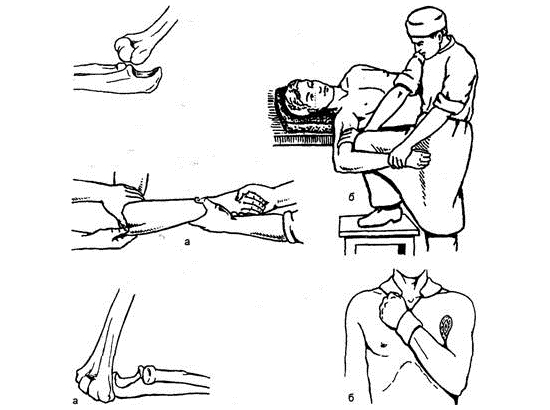 Вправление вывиха предплечья Вправление вывиха предплечья
