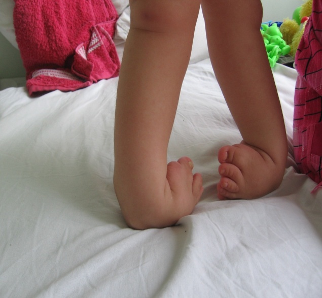 Врожденная косолапость Врожденная косолапость