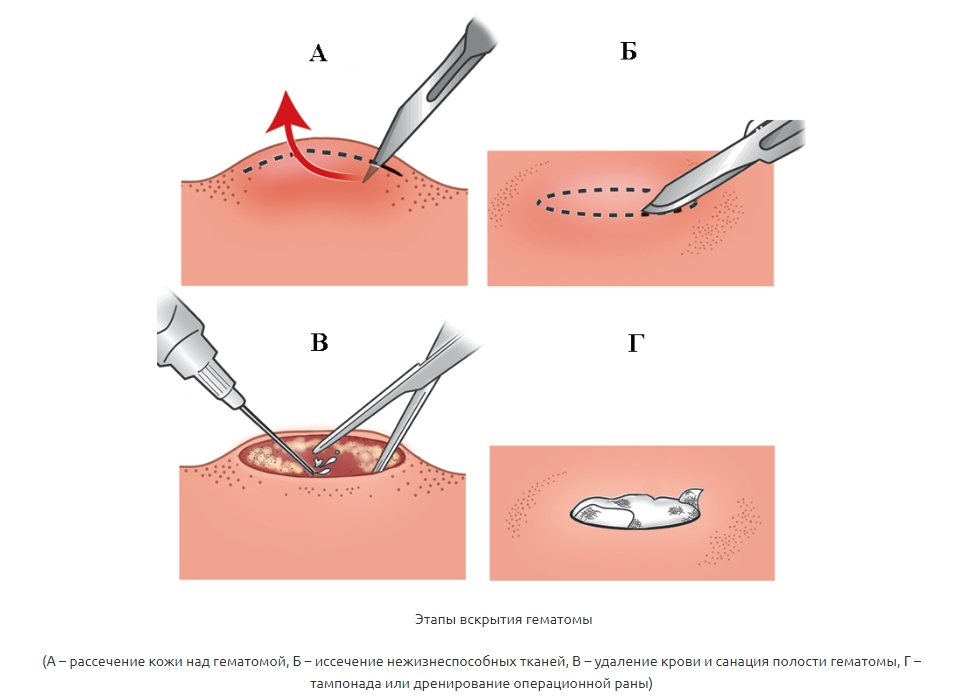 Этапы вскрытия гематомы Этапы вскрытия гематомы
