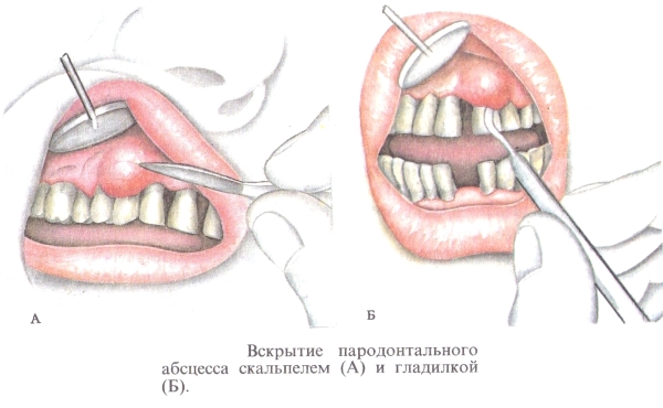 Вскрытие надкостничного абсцесса Вскрытие надкостничного абсцесса
