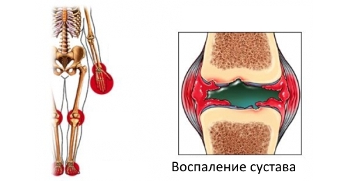 Воспаление сустава Воспаление сустава