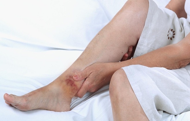 Втирание раствора в место ушиба