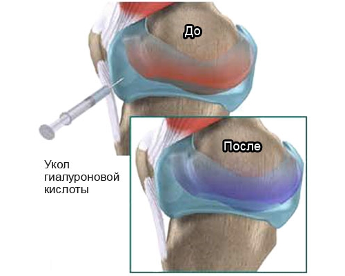 Введение укола гиалуроновой кислоты