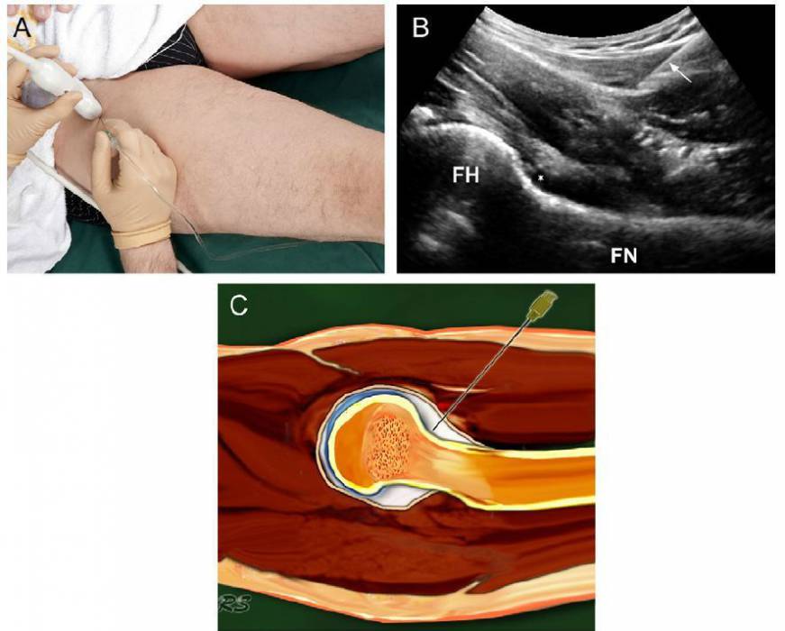 Введение инъекции под контролем УЗИ Введение инъекции под контролем УЗИ
